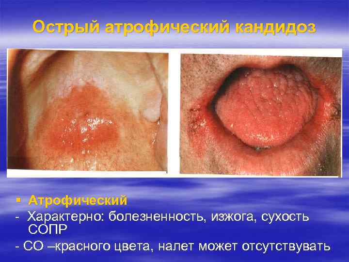 Острый атрофический кандидоз Атрофический - Характерно: болезненность, изжога, сухость СОПР - СО –красного цвета,