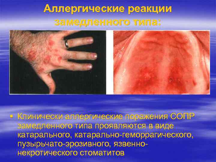 Аллергические реакции замедленного типа: Клинически аллергические поражения СОПР замедленного типа проявляются в виде катарального,