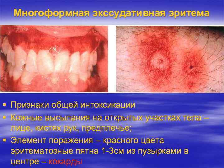 Многоформная экссудативная эритема Признаки общей интоксикации Кожные высыпания на открытых участках тела – лице,