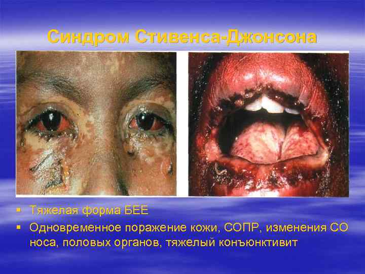 Синдром Стивенса-Джонсона Тяжелая форма БЕЕ Одновременное поражение кожи, СОПР, изменения СО носа, половых органов,