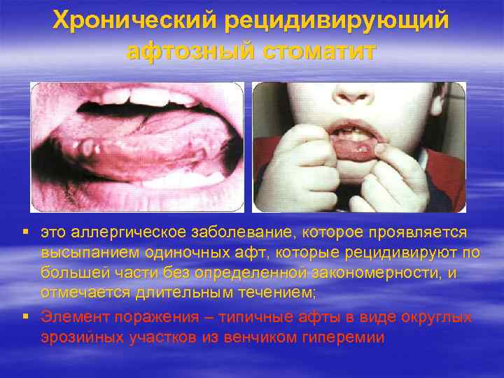 Хронический рецидивирующий афтозный стоматит это аллергическое заболевание, которое проявляется высыпанием одиночных афт, которые рецидивируют