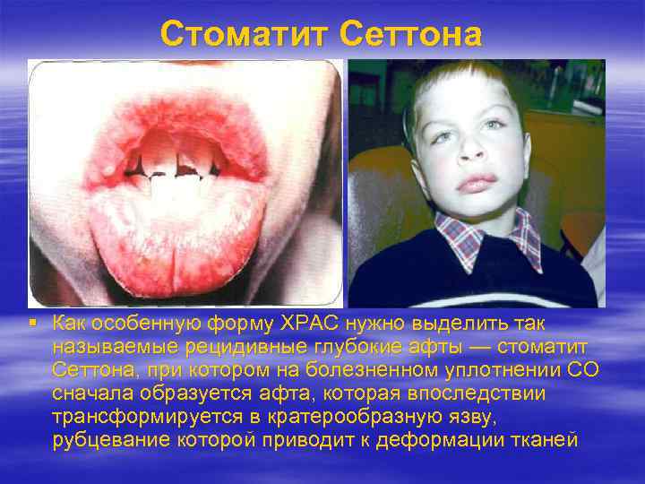 Стоматит Сеттона Как особенную форму ХРАС нужно выделить так называемые рецидивные глубокие афты —