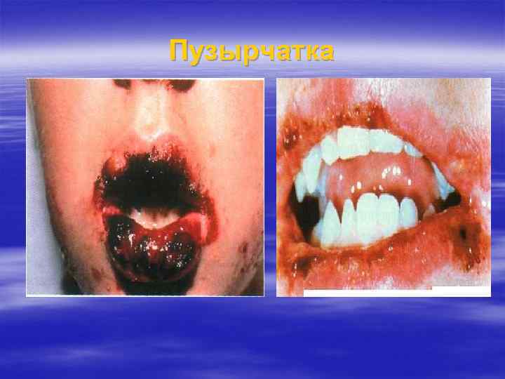 Пузырчатка 