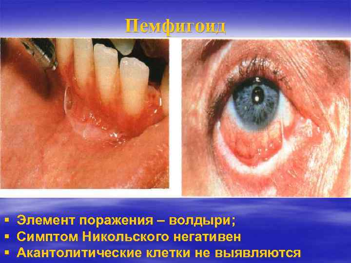 Пемфигоид Элемент поражения – волдыри; Симптом Никольского негативен Акантолитические клетки не выявляются 