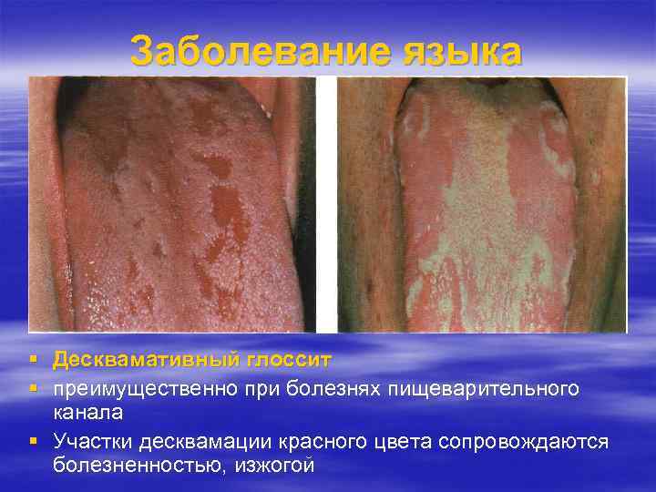 Заболевание языка Десквамативный глоссит преимущественно при болезнях пищеварительного канала Участки десквамации красного цвета сопровождаются