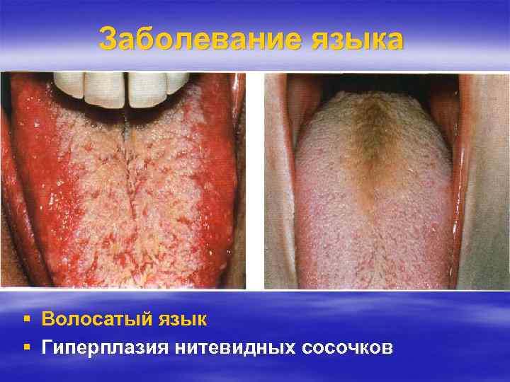 Заболевание языка Волосатый язык Гиперплазия нитевидных сосочков 