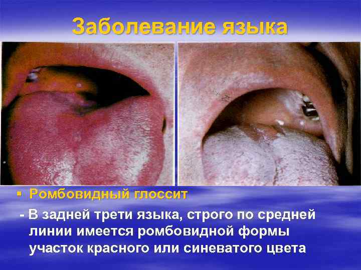 Заболевание языка Ромбовидный глоссит - В задней трети языка, строго по средней линии имеется