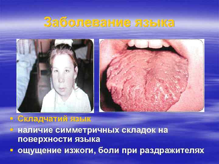 Заболевание языка Складчатий язык наличие симметричных складок на поверхности языка ощущение изжоги, боли при