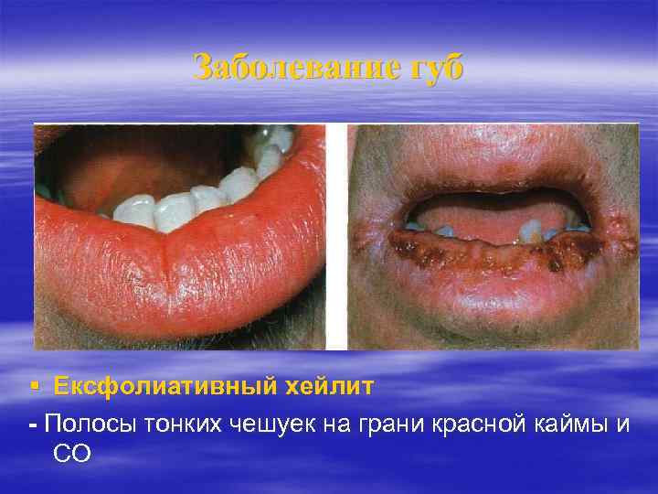 Заболевание губ Ексфолиативный хейлит - Полосы тонких чешуек на грани красной каймы и СО