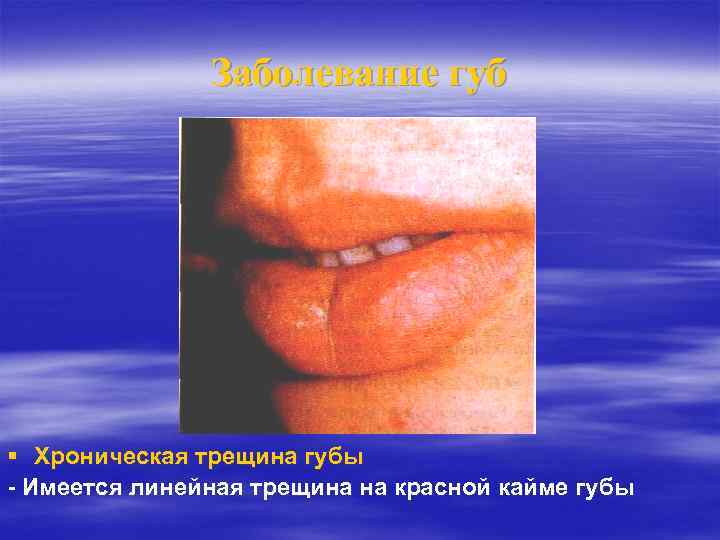 Заболевание губ Хроническая трещина губы - Имеется линейная трещина на красной кайме губы 