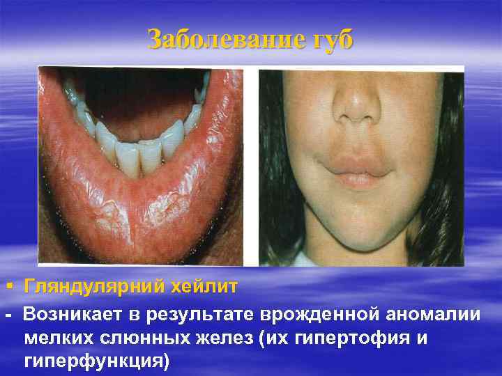 Заболевание губ Гляндулярний хейлит - Возникает в результате врожденной аномалии мелких слюнных желез (их