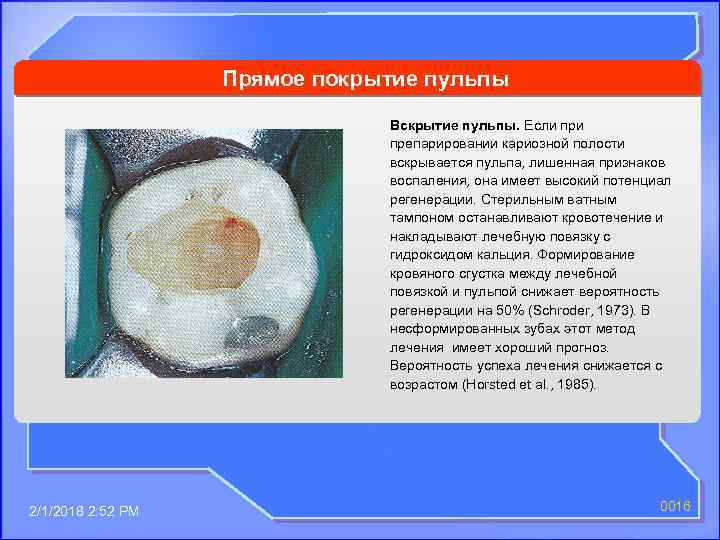 Прямое покрытие пульпы Вскрытие пульпы. Если препарировании кариозной полости вскрывается пульпа, лишенная признаков воспаления,