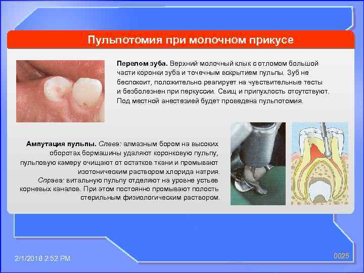 Пульпотомия при молочном прикусе Перелом зуба. Верхний молочный клык с отломом большой части коронки