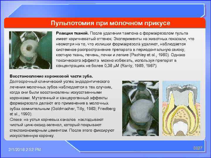Пульпотомия при молочном прикусе Реакция тканей. После удаления тампона с формакрезолом пульпа имеет коричневатый