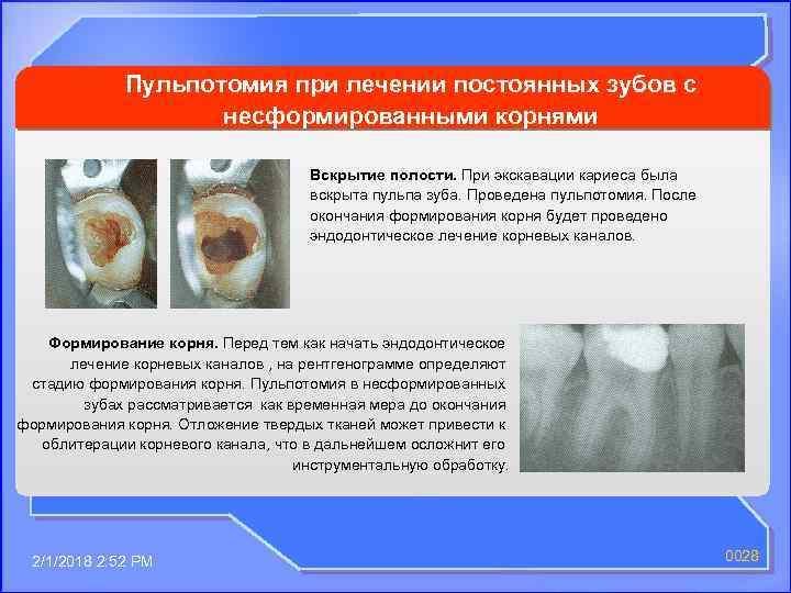 Повторное эндодонтическое лечение презентация