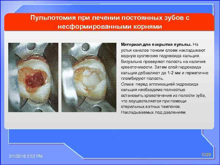 Пульпотомия при лечении постоянных зубов с несформированными корнями Материал для покрытия пульпы. На устья