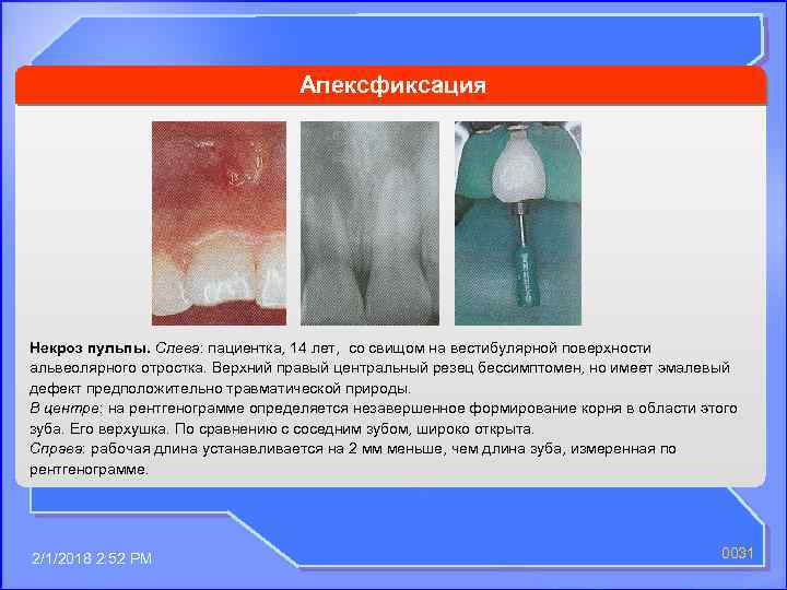 Апексфиксация Некроз пульпы. Слева: пациентка, 14 лет, со свищом на вестибулярной поверхности альвеолярного отростка.