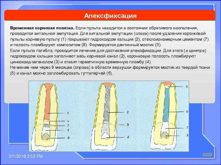 Апексфиксация Временная корневая повязка. Если пульпа находится в состоянии обратимого воспаления, проводится витальная ампутация.