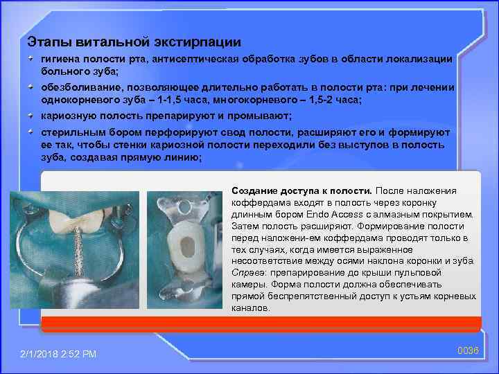 Этапы витальной экстирпации гигиена полости рта, антисептическая обработка зубов в области локализации больного зуба;