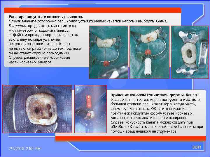Расширение устьев корневых каналов. Слева: вначале осторожно расширяют устья корневых каналов небольшим бором Gates.