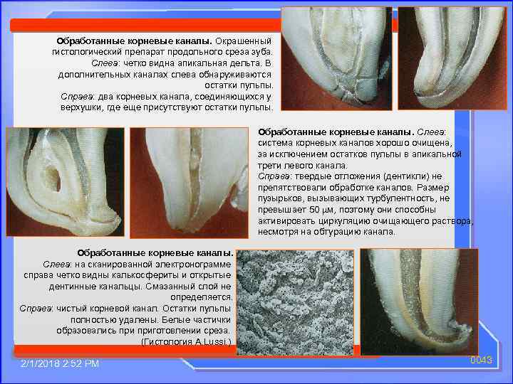 Обработанные корневые каналы. Окрашенный гистологический препарат продольного среза зуба. Слева: четко видна апикальная дельта.