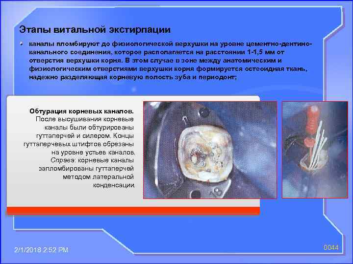 Этапы витальной экстирпации каналы пломбируют до физиологической верхушки на уровне цементно-дентиноканального соединения, которое располагается