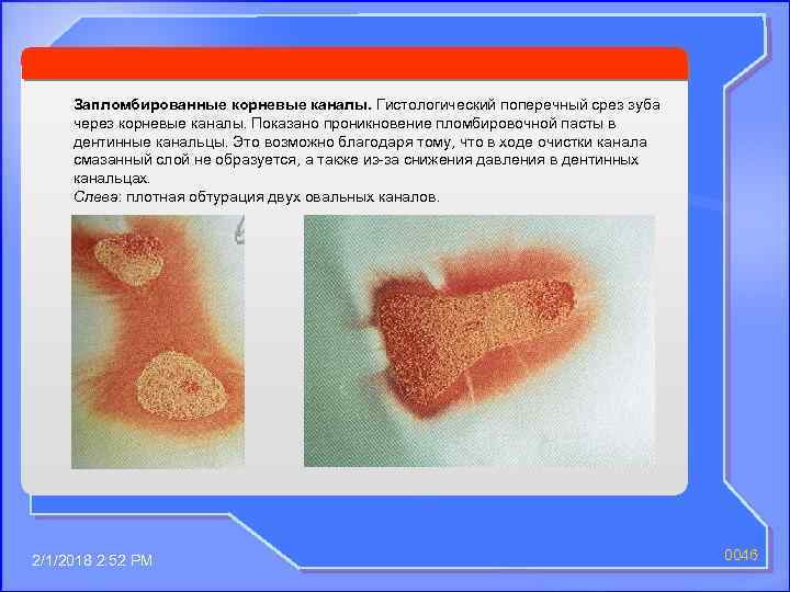 Запломбированные корневые каналы. Гистологический поперечный срез зуба через корневые каналы. Показано проникновение пломбировочной пасты