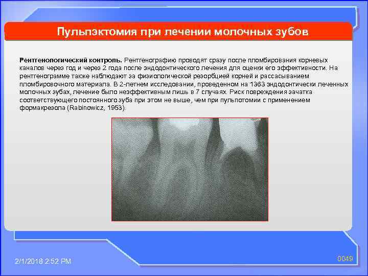 Пульпэктомия при лечении молочных зубов Рентгенологический контроль. Рентгенографию проводят сразу после пломбирования корневых каналов