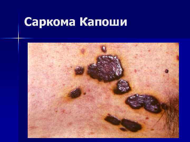 Саркома Капоши 
