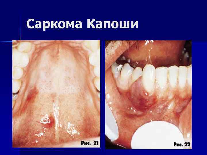 Саркома Капоши 