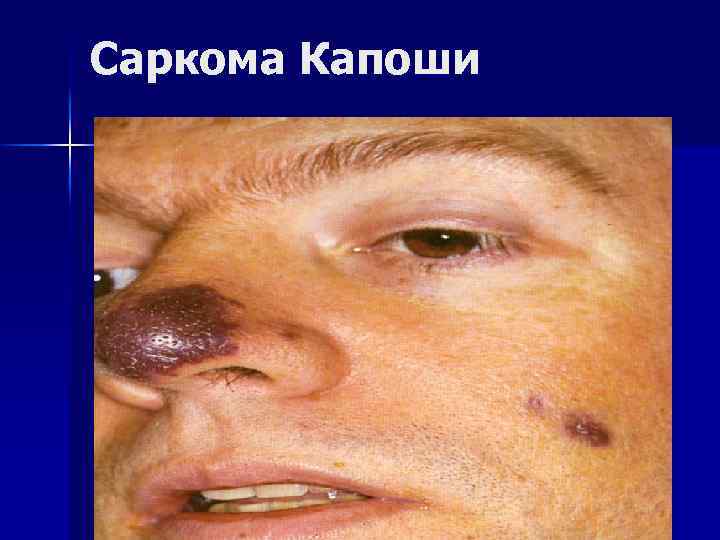 Саркома Капоши 