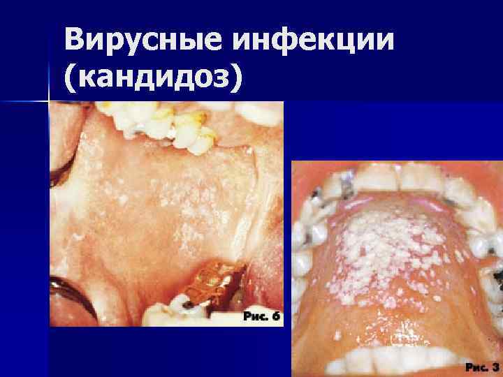 Вирусные инфекции (кандидоз) 