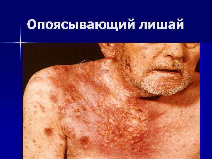 Опоясывающий лишай 