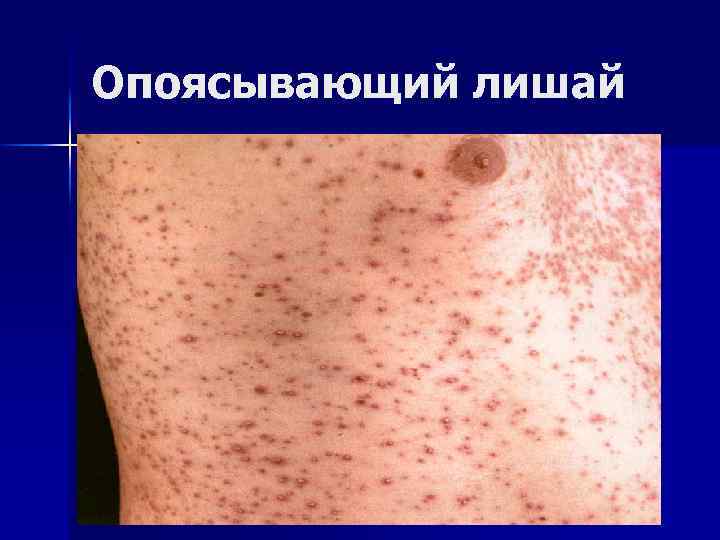Опоясывающий лишай 