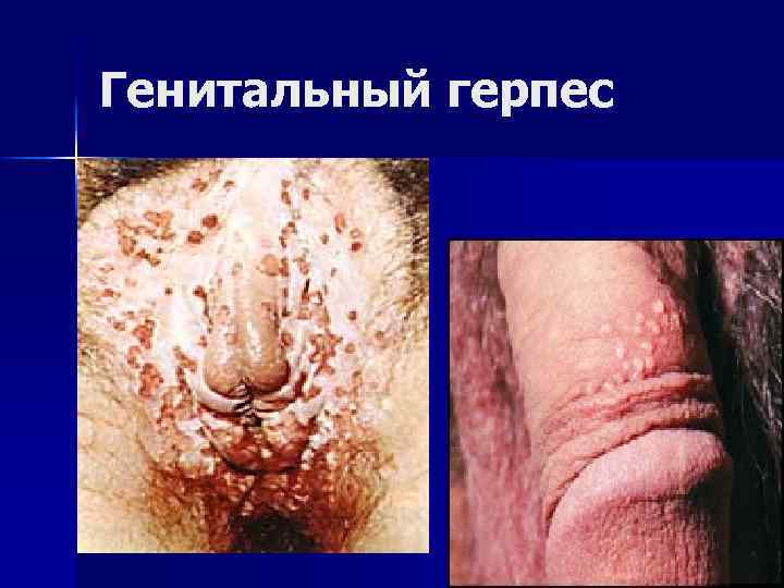 Генитальный герпес 