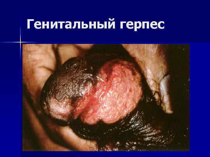 Генитальный герпес 