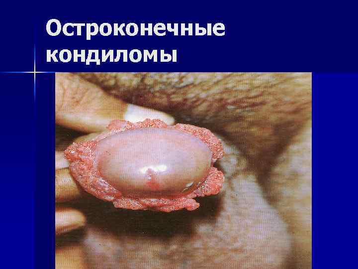 Остроконечные кондиломы 