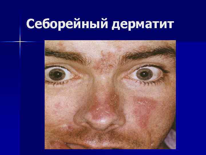 Себорейный дерматит 