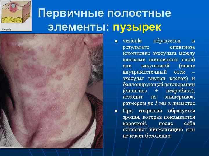 Первичные полостные элементы: пузырек n n vesicula образуется в результате спонгиоза (скопление экссудата между