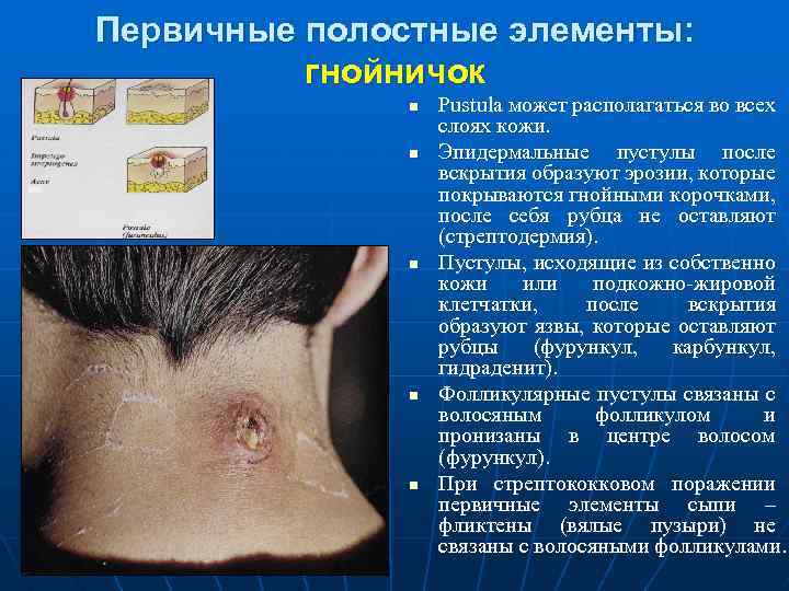 Первичные полостные элементы: гнойничок n n n Pustula может располагаться во всех слоях кожи.