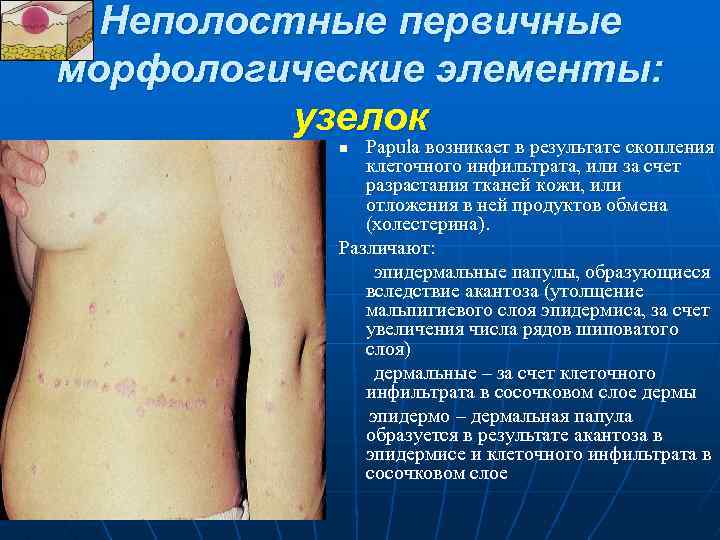 Неполостные первичные морфологические элементы: узелок Papula возникает в результате скопления клеточного инфильтрата, или за