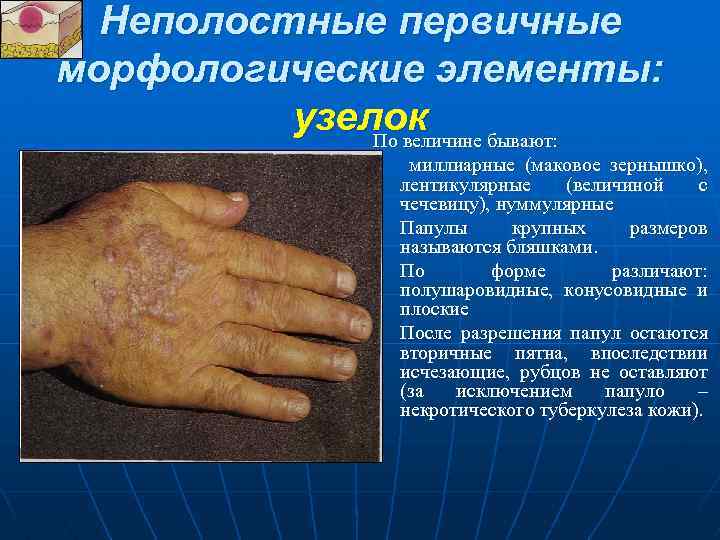 Неполостные первичные морфологические элементы: узелок бывают: По величине n n миллиарные (маковое зернышко), лентикулярные