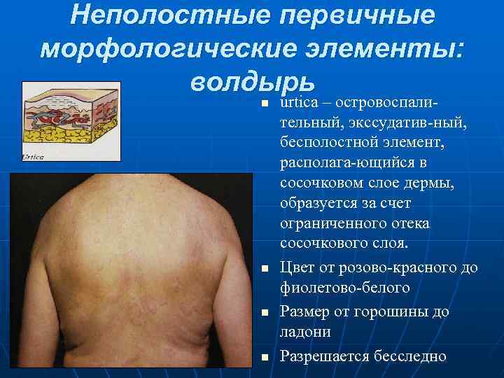 Неполостные первичные морфологические элементы: волдырь n n urtica – островоспали тельный, экссудатив ный, бесполостной