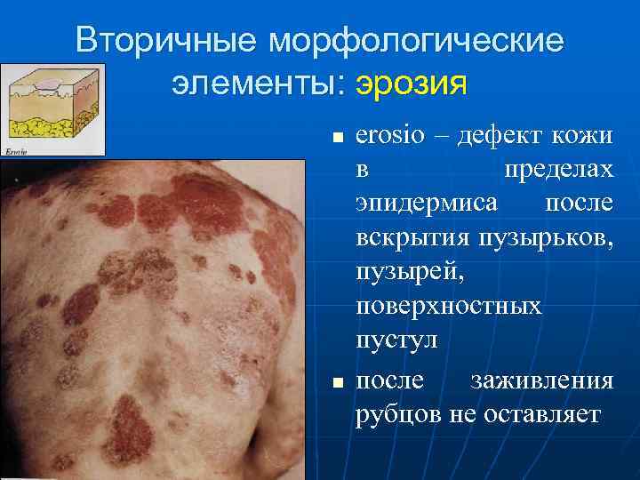 Вторичные морфологические элементы: эрозия n n erosio – дефект кожи в пределах эпидермиса после