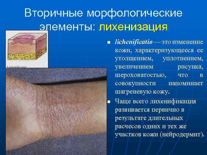 Вторичные морфологические элементы: лихенизация n n lichenificatio — это изменение кожи, характеризующееся ее утолщением,