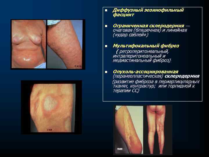 n n Диффузный эозинофильный фасциит Ограниченная склеродермия — очаговая (бляшечная) и линейная ( «удар