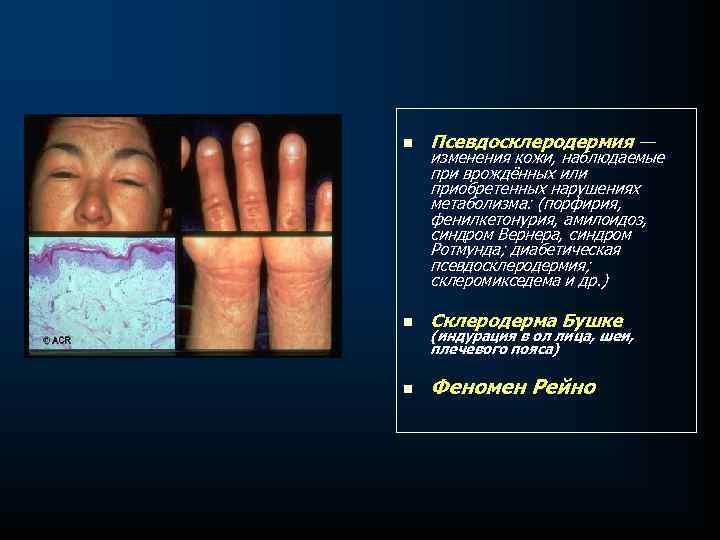 n Псевдосклеродермия — n Склеродерма Бушке n Феномен Рейно изменения кожи, наблюдаемые при врождённых
