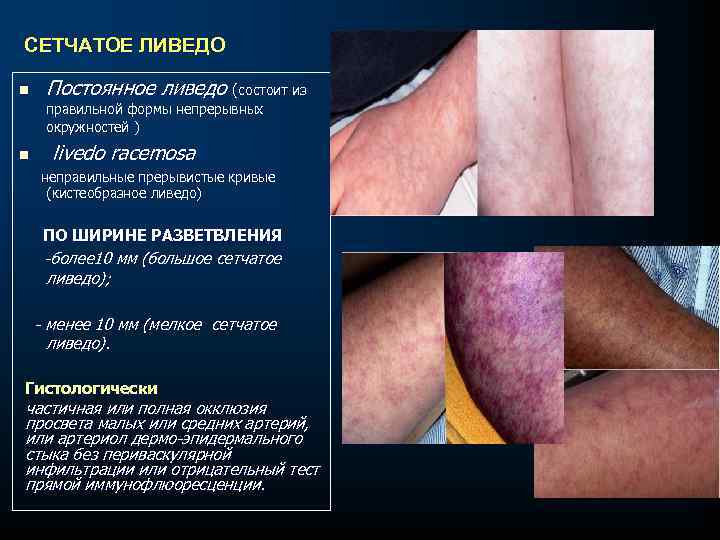  СЕТЧАТОЕ ЛИВЕДО n Постоянное ливедо (состоит из правильной формы непрерывных окружностей ) n