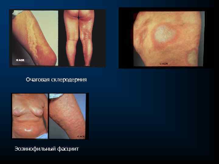 Очаговая склеродермия Эозинофильный фасциит 