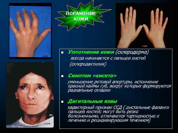 ПОРАЖЕНИЕ КОЖИ n Уплотнение кожи (склеродерма) всегда начинается с пальцев кистей (склеродактилия) n Симптом